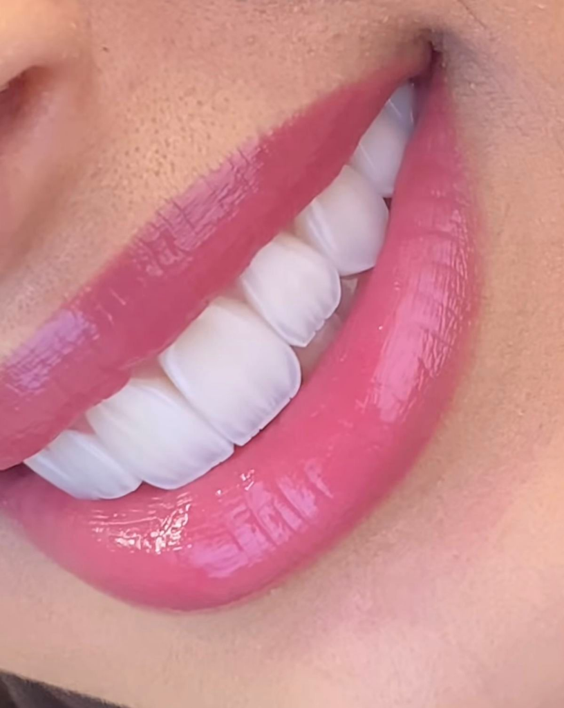 E-max Veneers Detail