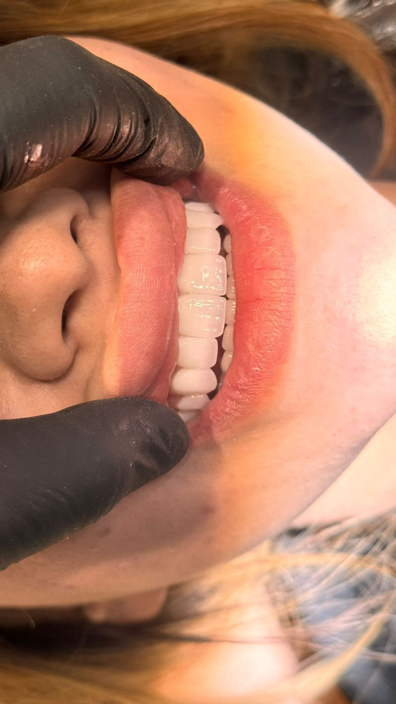 E-max Veneers
