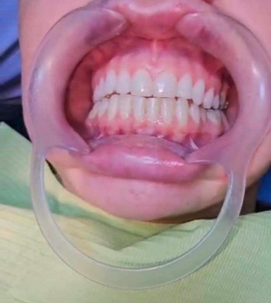 Esthetic Restoration