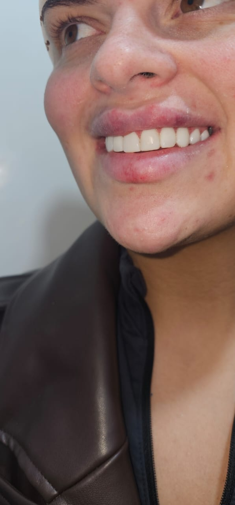 Natural Smile Makeover