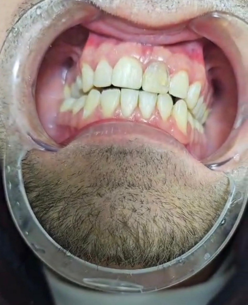 Smile Transformation