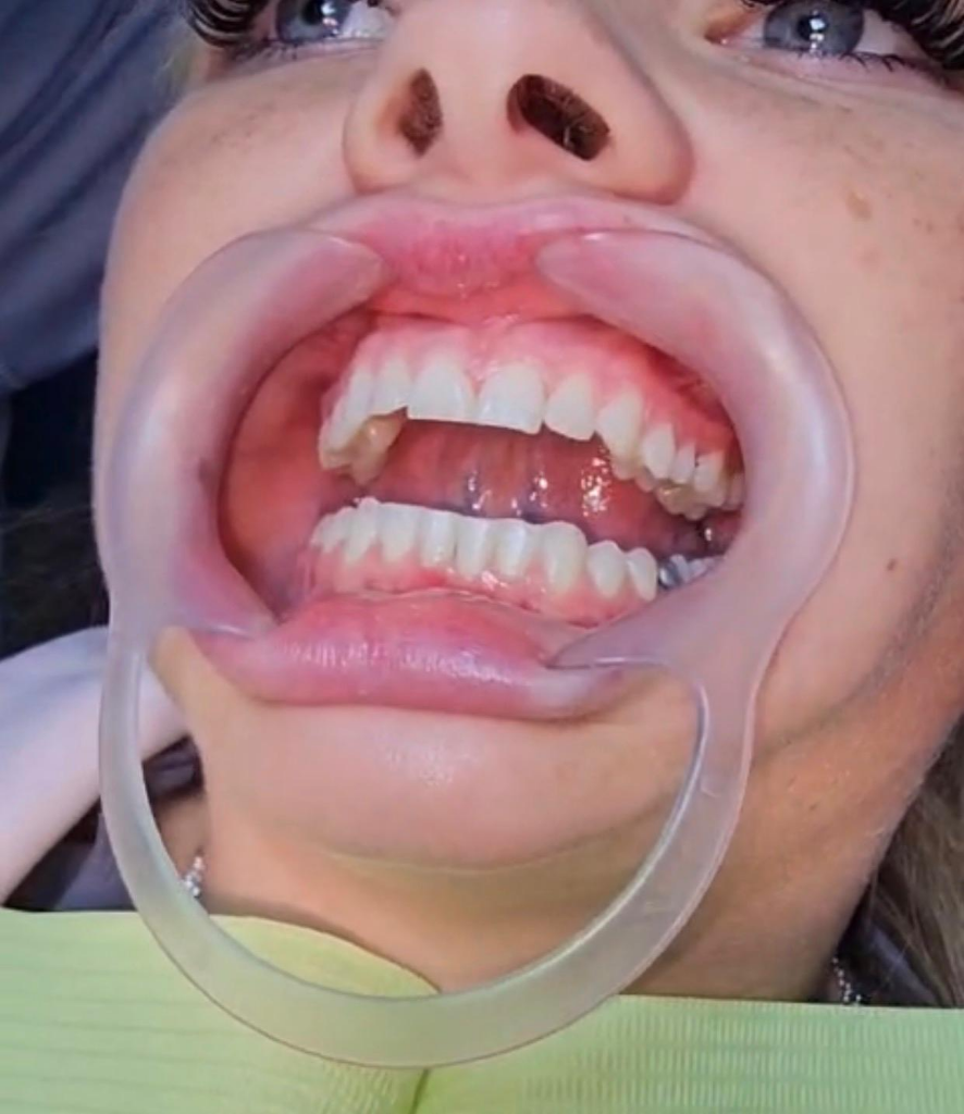 E-max Veneers